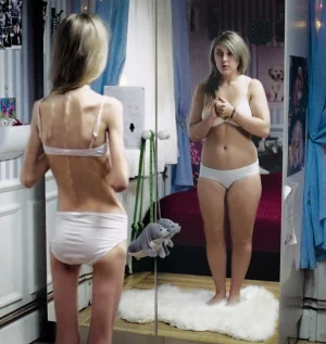 anorexia.webp