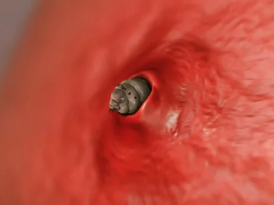 botfly-removal.webp