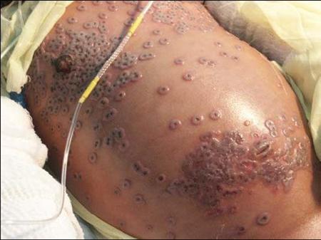 2-Year-Old-Smallpox-Reuters.jpg