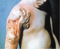 Progressive-Vaccinia-Smallpox-Vaccination-Child-with-Leukemia.jpg