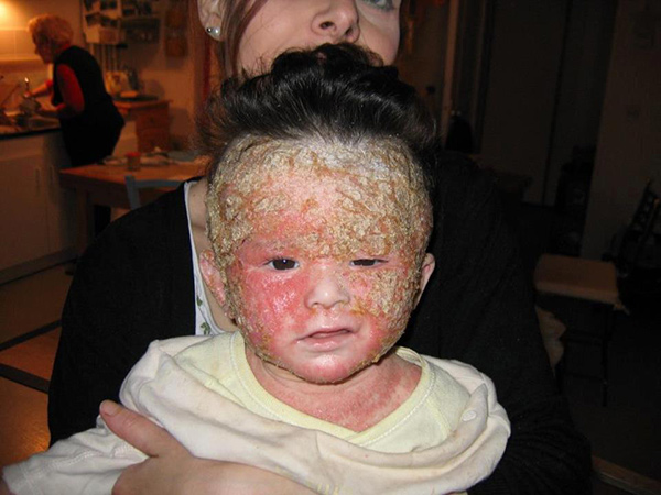 Theodore-Severe-Eczema.jpg