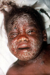 Eczema-Vaccinatum-Face-John-M-Leedom.jpg