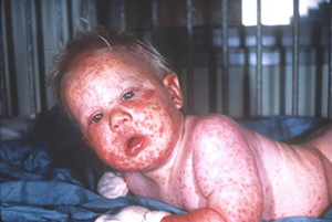 Generalized-Vaccinia-John-M-Leedom.jpg
